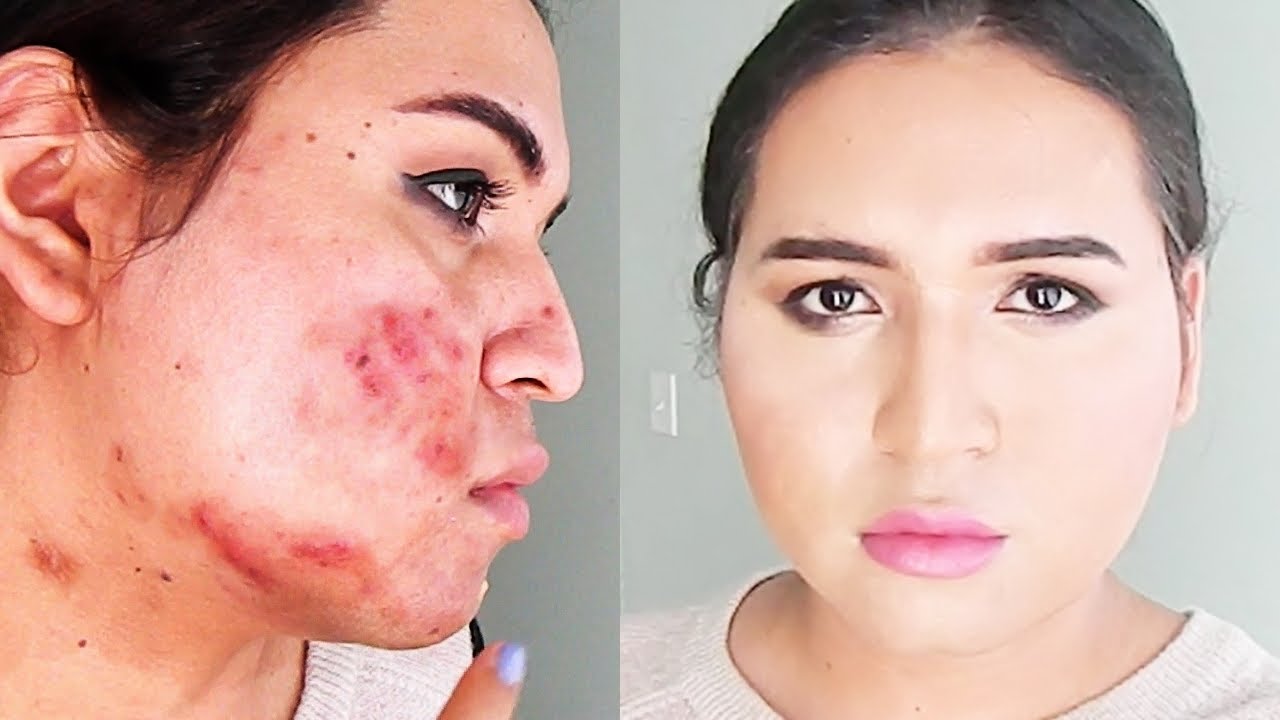 Mi Rutina De Maquillaje Para Cubrir El Acne - Healthy Tips