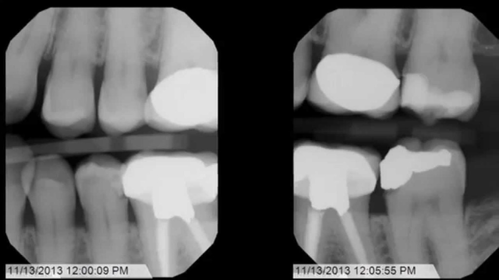 Ideas and Tips for Bitewing XRays Healthy Tips